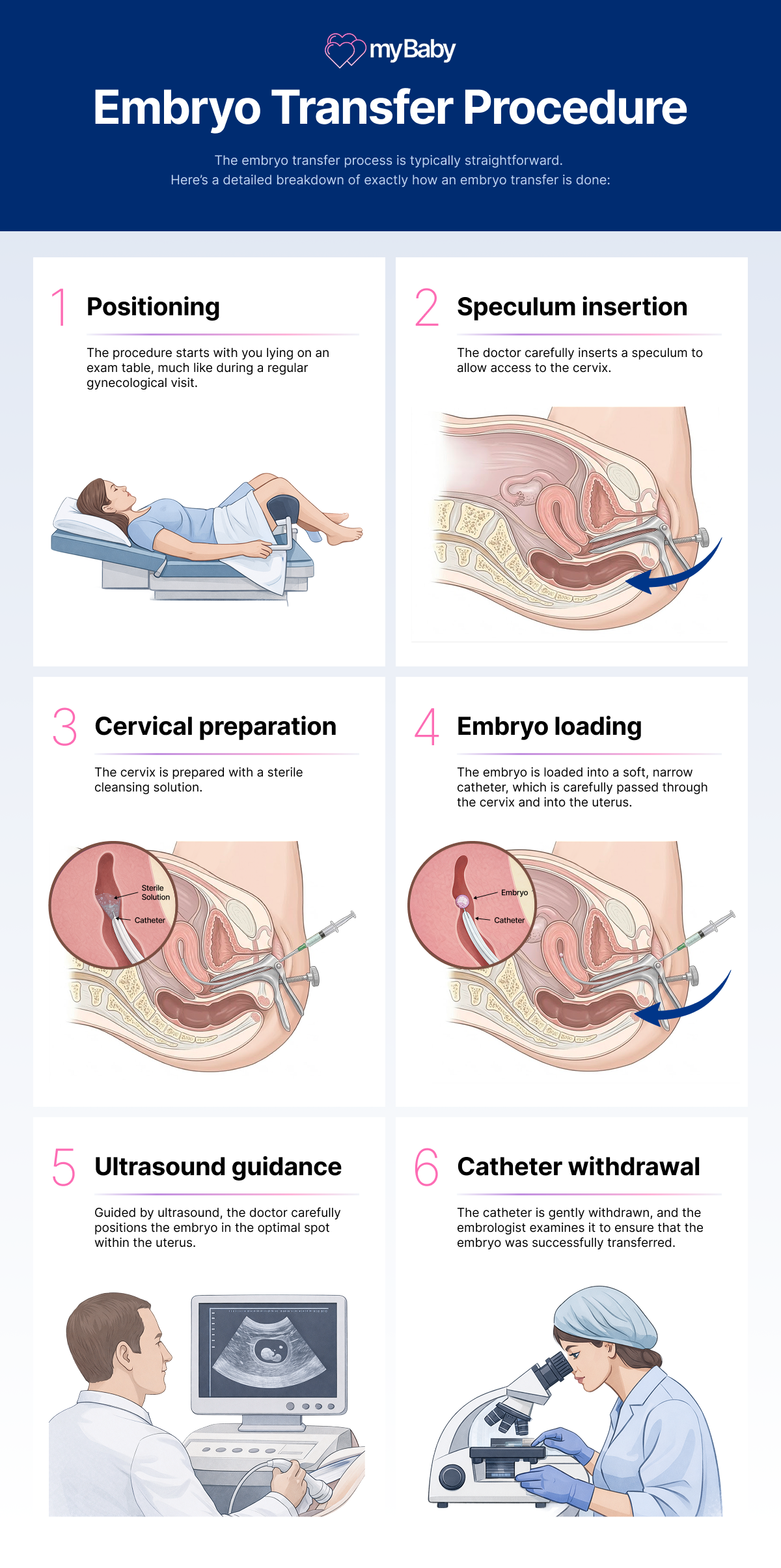 Infographic showing the six steps of the embryo transfer procedure: positioning, speculum insertion, cervical preparation, embryo loading, ultrasound guidance, and catheter withdrawal